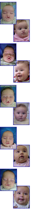 Fotos de bebes com fissura lábio palatal