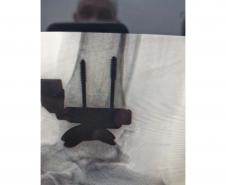 Hospital do Trabalhador realiza primeira cirurgia de artroplastia de tornozelo no SUS no Paraná