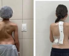 Estrutura e equipe: Paraná é referência em cirurgias de deformidade da coluna vertebral
