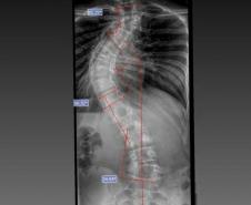 Estrutura e equipe: Paraná é referência em cirurgias de deformidade da coluna vertebral