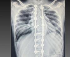 Estrutura e equipe: Paraná é referência em cirurgias de deformidade da coluna vertebral