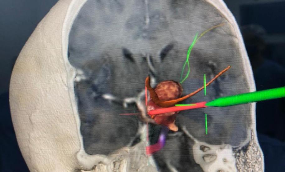 Foi realizada hoje (12), no Complexo do Hospital do Trabalhador, a primeira cirurgia computadorizada utilizando equipamento de última geração adquirido com recursos da Secretaria de Estado da Saúde, repassados do Ministério Público do Trabalho.