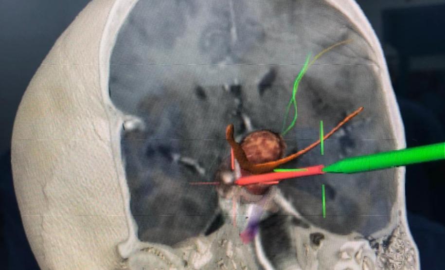 Foi realizada hoje (12), no Complexo do Hospital do Trabalhador, a primeira cirurgia computadorizada utilizando equipamento de última geração adquirido com recursos da Secretaria de Estado da Saúde, repassados do Ministério Público do Trabalho.