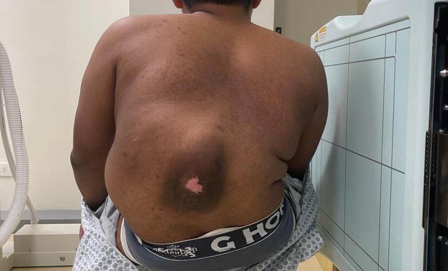 Junho Verde: Saúde alerta sobre importância do tratamento precoce da escoliose