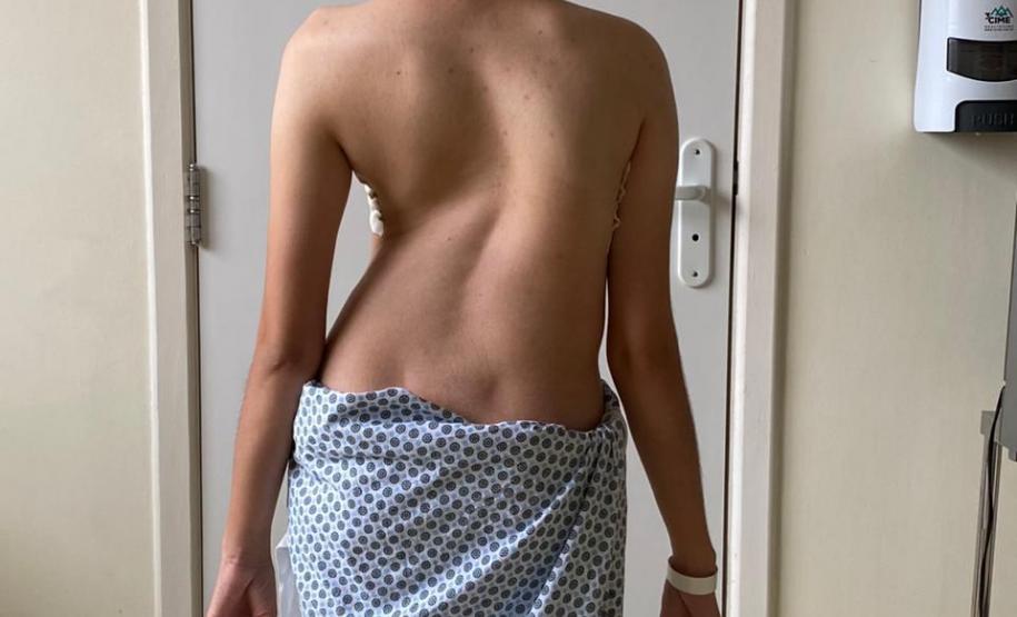 Junho Verde: Saúde alerta sobre importância do tratamento precoce da escoliose