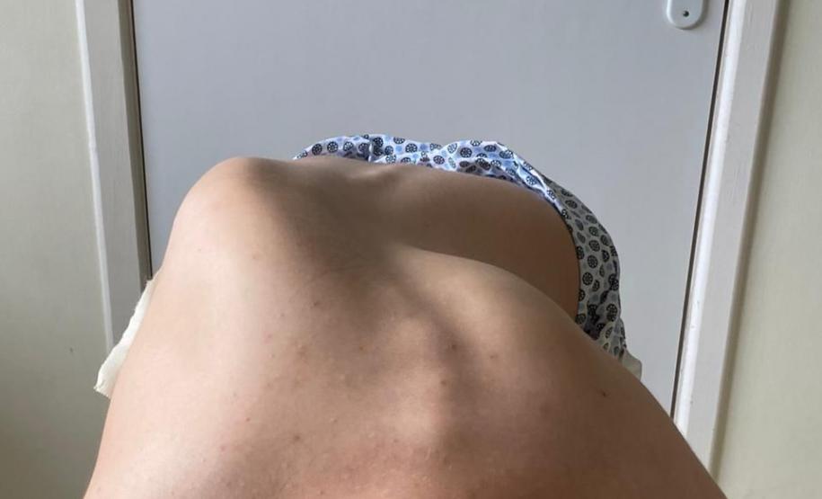 Junho Verde: Saúde alerta sobre importância do tratamento precoce da escoliose