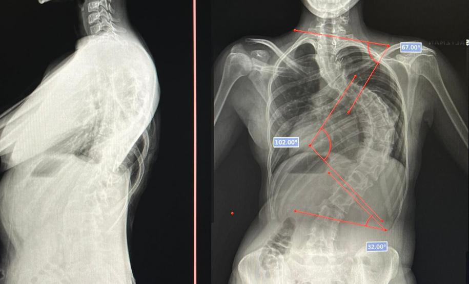 Junho Verde: Saúde alerta sobre importância do tratamento precoce da escoliose