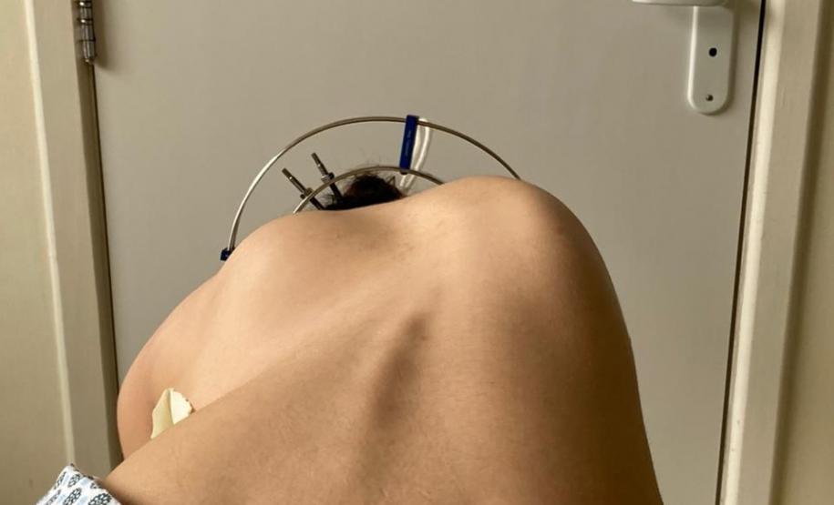 Junho Verde: Saúde alerta sobre importância do tratamento precoce da escoliose