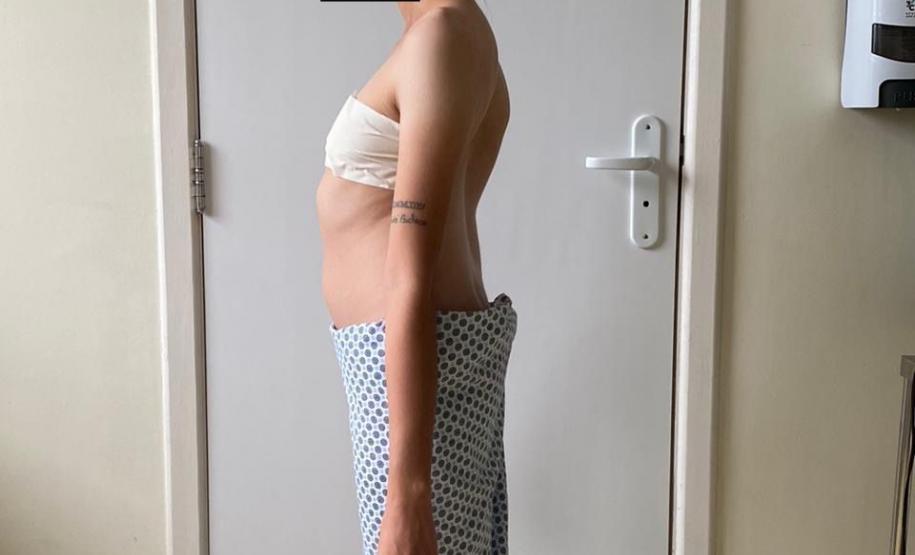 Junho Verde: Saúde alerta sobre importância do tratamento precoce da escoliose