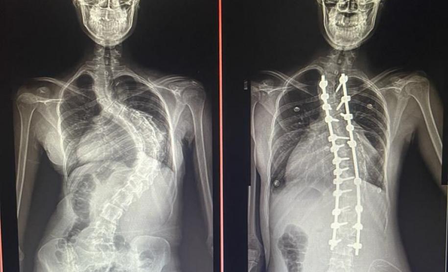 Junho Verde: Saúde alerta sobre importância do tratamento precoce da escoliose