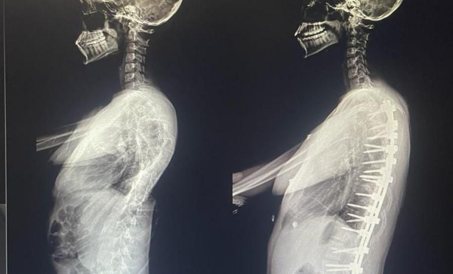 Junho Verde: Saúde alerta sobre importância do tratamento precoce da escoliose