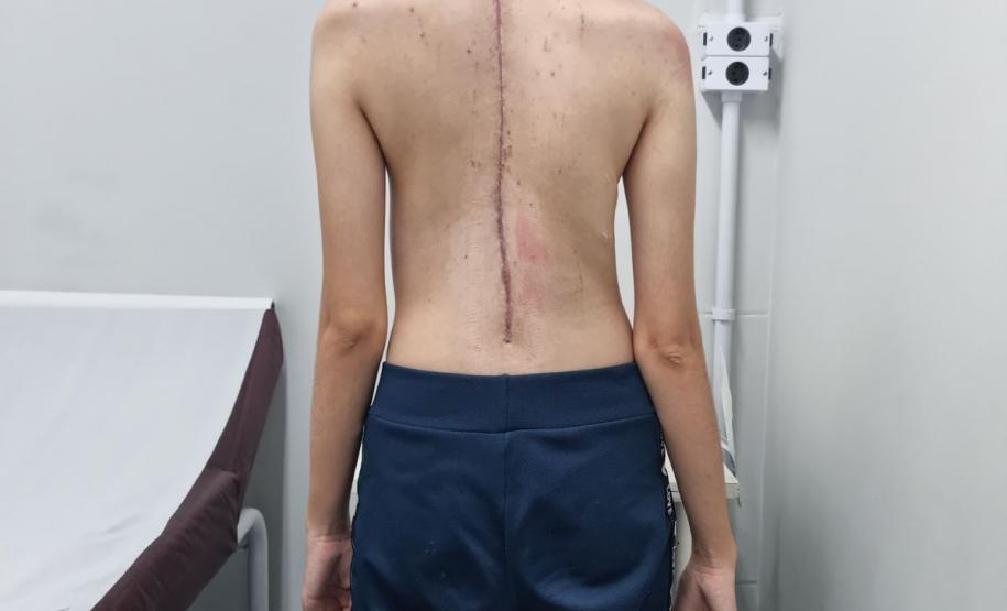 Junho Verde: Saúde alerta sobre importância do tratamento precoce da escoliose