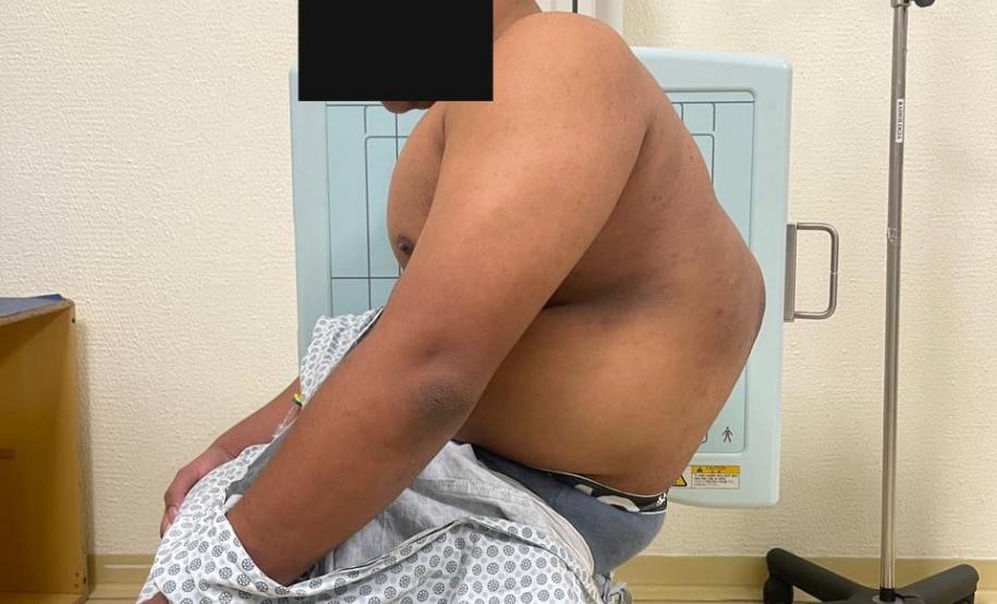 Junho Verde: Saúde alerta sobre importância do tratamento precoce da escoliose