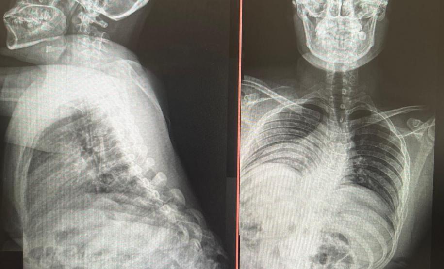 Junho Verde: Saúde alerta sobre importância do tratamento precoce da escoliose