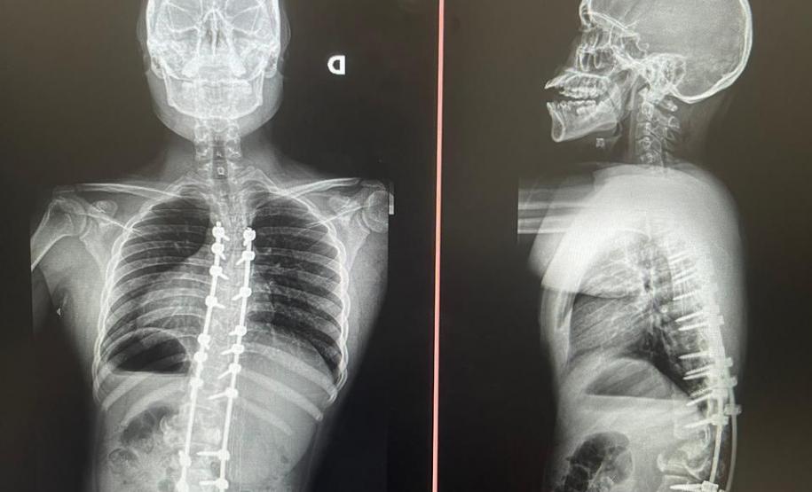 Junho Verde: Saúde alerta sobre importância do tratamento precoce da escoliose