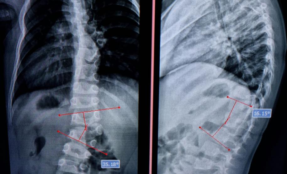 Junho Verde: Saúde alerta sobre importância do tratamento precoce da escoliose