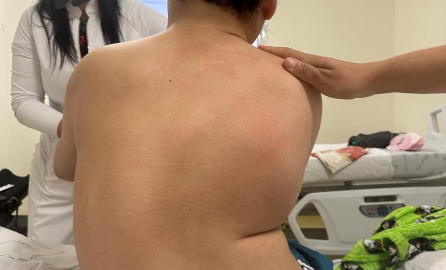 Junho Verde: Saúde alerta sobre importância do tratamento precoce da escoliose