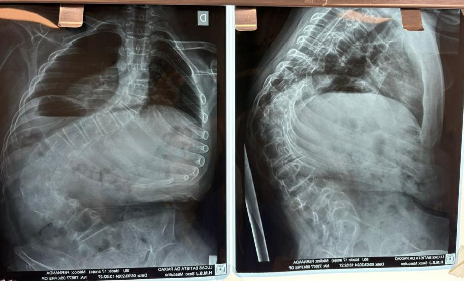 Junho Verde: Saúde alerta sobre importância do tratamento precoce da escoliose