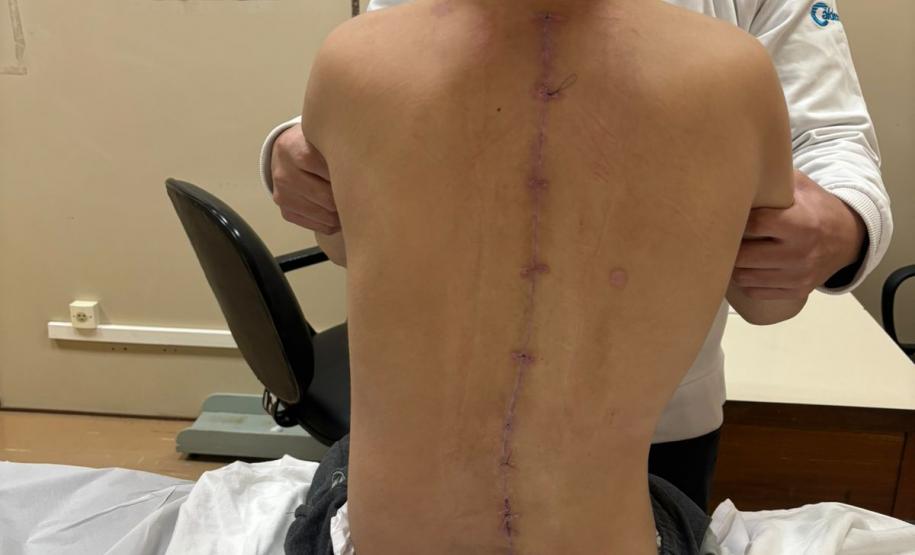 Junho Verde: Saúde alerta sobre importância do tratamento precoce da escoliose