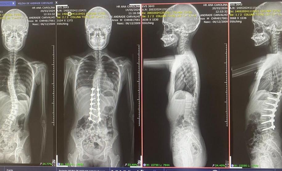 Junho Verde: Saúde alerta sobre importância do tratamento precoce da escoliose