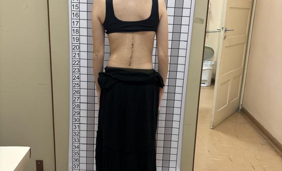 Junho Verde: Saúde alerta sobre importância do tratamento precoce da escoliose