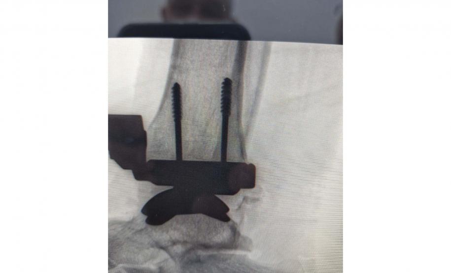 Hospital do Trabalhador realiza primeira cirurgia de artroplastia de tornozelo no SUS no Paraná