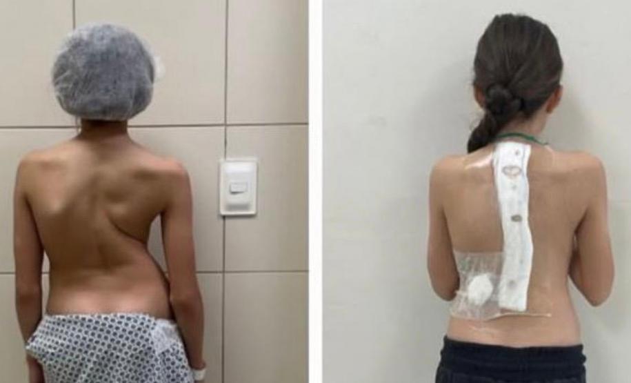 Estrutura e equipe: Paraná é referência em cirurgias de deformidade da coluna vertebral