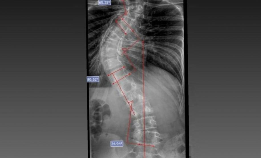 Estrutura e equipe: Paraná é referência em cirurgias de deformidade da coluna vertebral