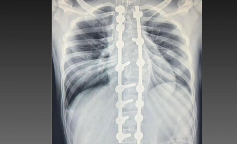 Estrutura e equipe: Paraná é referência em cirurgias de deformidade da coluna vertebral